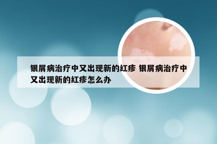 银屑病治疗中又出现新的红疹 银屑病治疗中又出现新的红疹怎么办