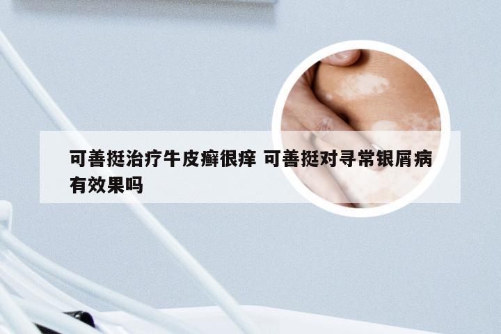 可善挺治疗牛皮癣很痒 可善挺对寻常银屑病有效果吗
