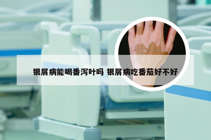 银屑病能喝番泻叶吗 银屑病吃番茄好不好