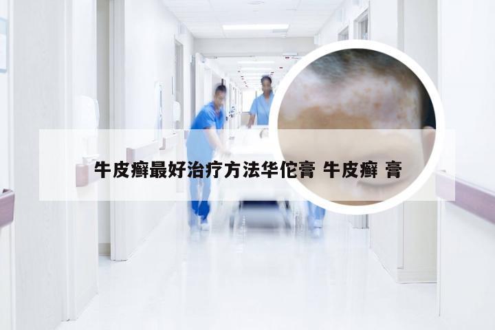 牛皮癣最好治疗方法华佗膏 牛皮癣 膏