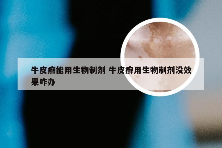 牛皮癣能用生物制剂 牛皮癣用生物制剂没效果咋办