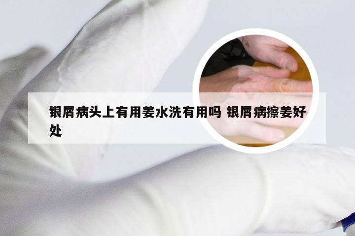 银屑病头上有用姜水洗有用吗 银屑病擦姜好处