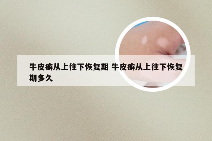 牛皮癣从上往下恢复期 牛皮癣从上往下恢复期多久