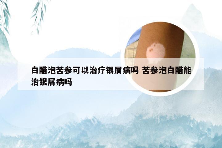 白醋泡苦参可以治疗银屑病吗 苦参泡白醋能治银屑病吗