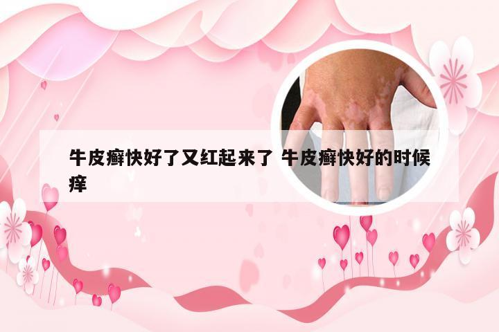 牛皮癣快好了又红起来了 牛皮癣快好的时候痒