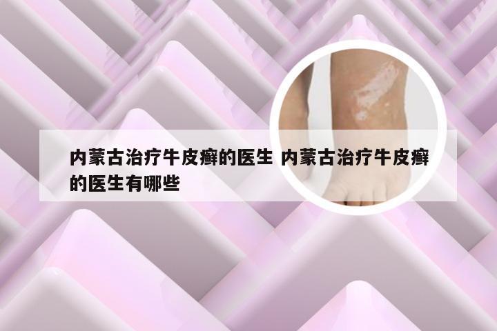 内蒙古治疗牛皮癣的医生 内蒙古治疗牛皮癣的医生有哪些