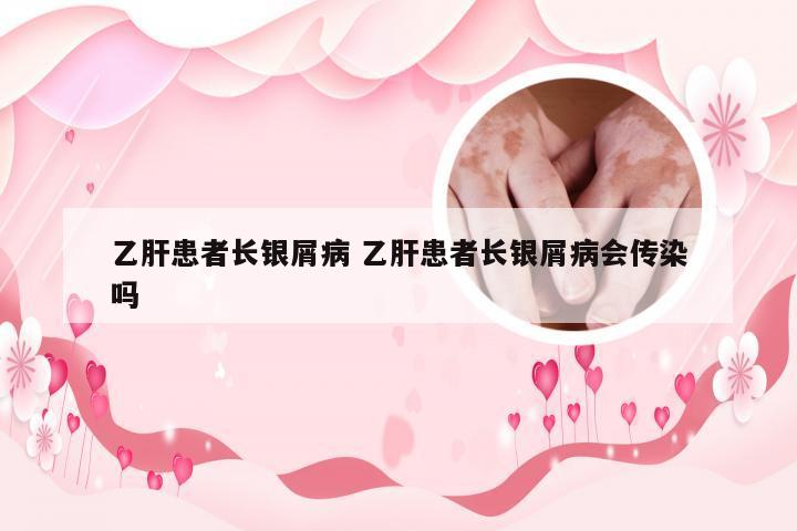 乙肝患者长银屑病 乙肝患者长银屑病会传染吗