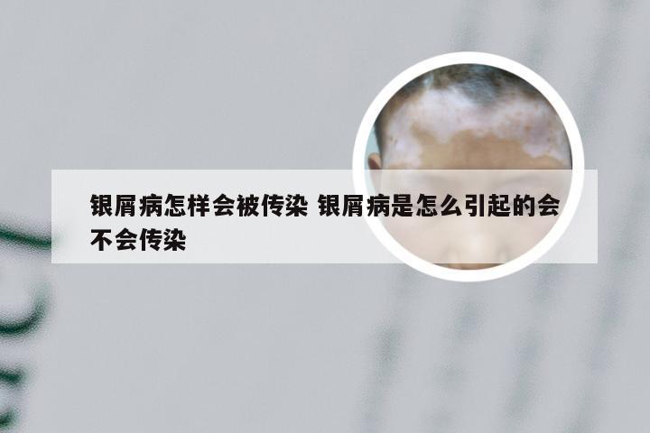 银屑病怎样会被传染 银屑病是怎么引起的会不会传染