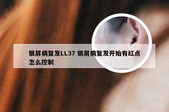 银屑病复发LL37 银屑病复发开始有红点怎么控制