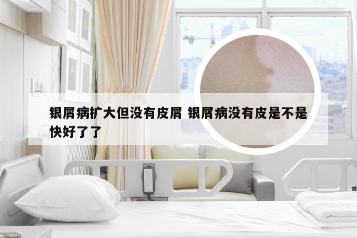 银屑病扩大但没有皮屑 银屑病没有皮是不是快好了了