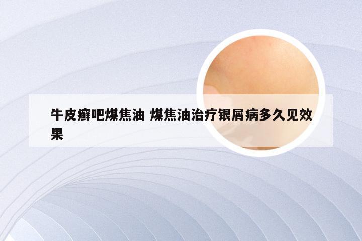 牛皮癣吧煤焦油 煤焦油治疗银屑病多久见效果