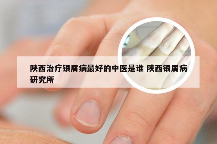 陕西治疗银屑病最好的中医是谁 陕西银屑病研究所