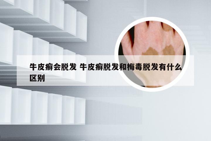 牛皮癣会脱发 牛皮癣脱发和梅毒脱发有什么区别