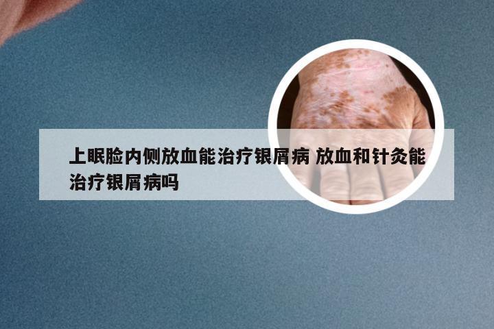 上眠脸内侧放血能治疗银屑病 放血和针灸能治疗银屑病吗