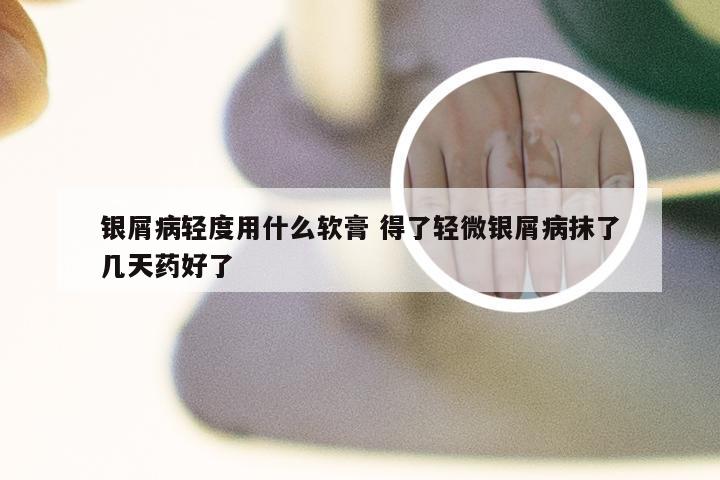 银屑病轻度用什么软膏 得了轻微银屑病抹了几天药好了