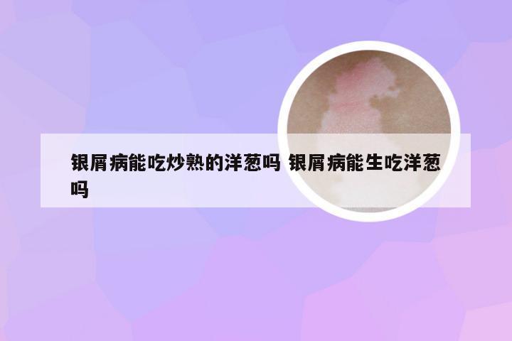 银屑病能吃炒熟的洋葱吗 银屑病能生吃洋葱吗