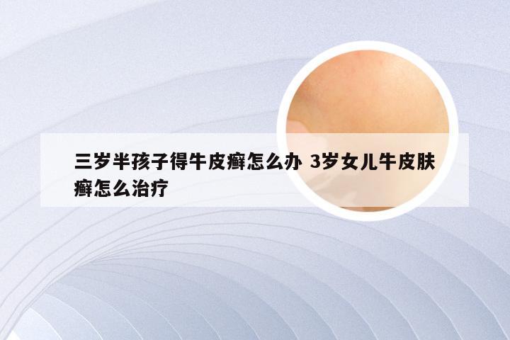 三岁半孩子得牛皮癣怎么办 3岁女儿牛皮肤癣怎么治疗