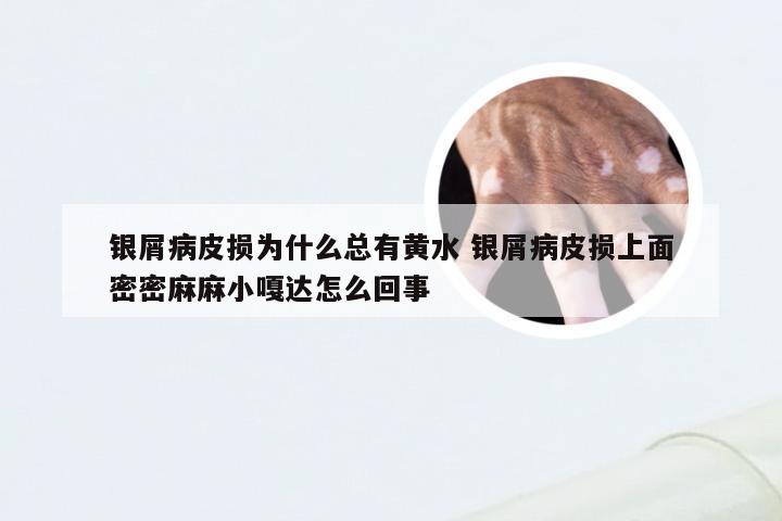 银屑病皮损为什么总有黄水 银屑病皮损上面密密麻麻小嘎达怎么回事