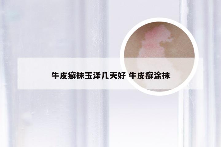 牛皮癣抹玉泽几天好 牛皮癣涂抹