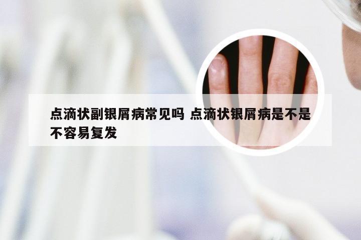 点滴状副银屑病常见吗 点滴状银屑病是不是不容易复发