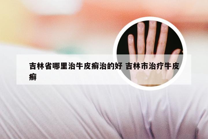 吉林省哪里治牛皮癣治的好 吉林市治疗牛皮癣