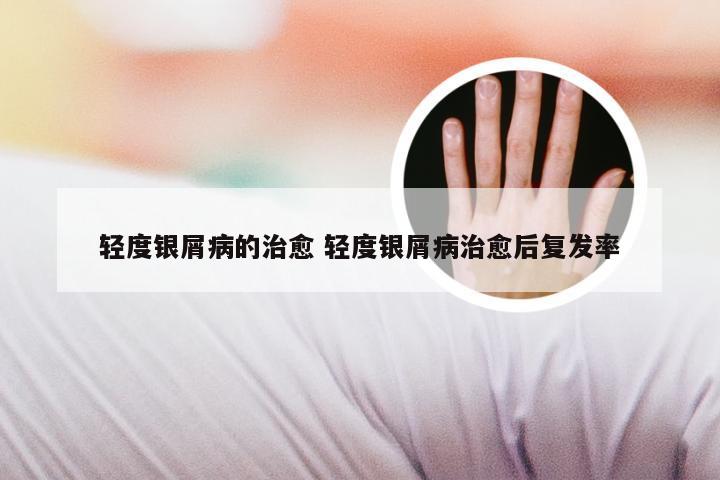 轻度银屑病的治愈 轻度银屑病治愈后复发率