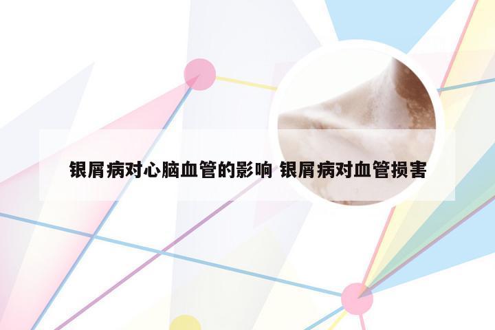 银屑病对心脑血管的影响 银屑病对血管损害