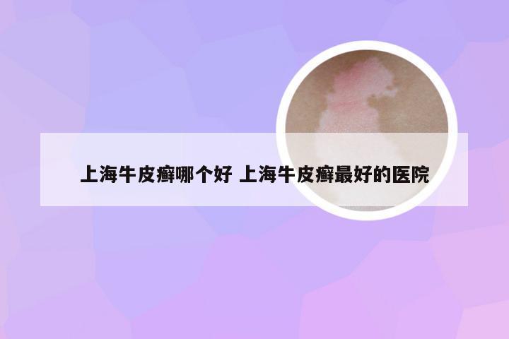 上海牛皮癣哪个好 上海牛皮癣最好的医院