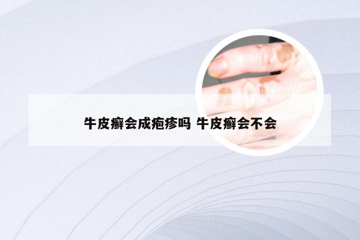 牛皮癣会成疱疹吗 牛皮癣会不会