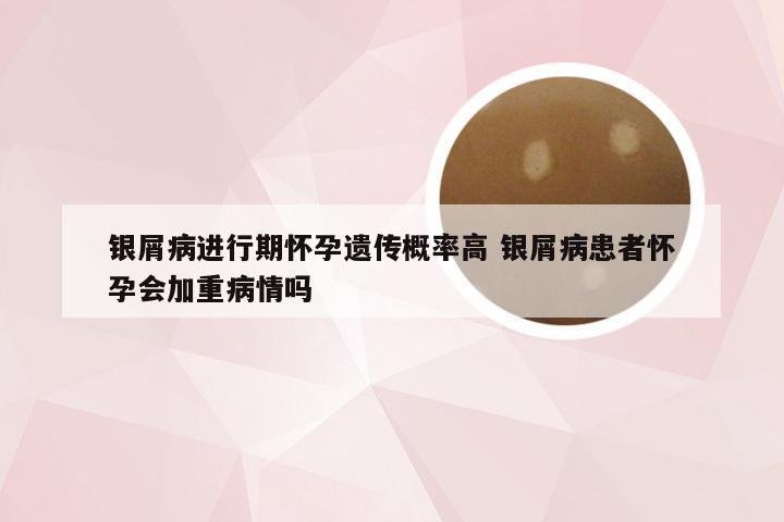银屑病进行期怀孕遗传概率高 银屑病患者怀孕会加重病情吗