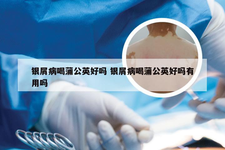 银屑病喝蒲公英好吗 银屑病喝蒲公英好吗有用吗