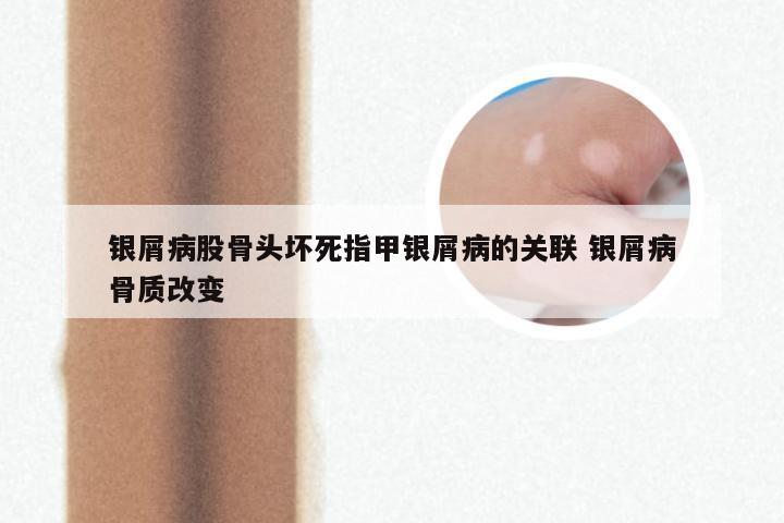 银屑病股骨头坏死指甲银屑病的关联 银屑病骨质改变