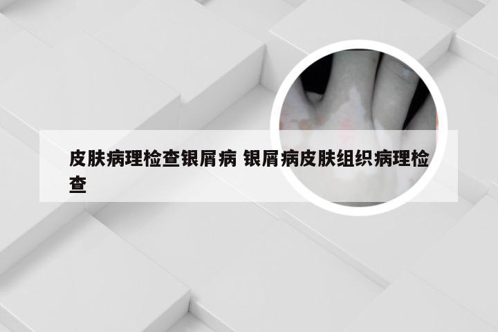 皮肤病理检查银屑病 银屑病皮肤组织病理检查