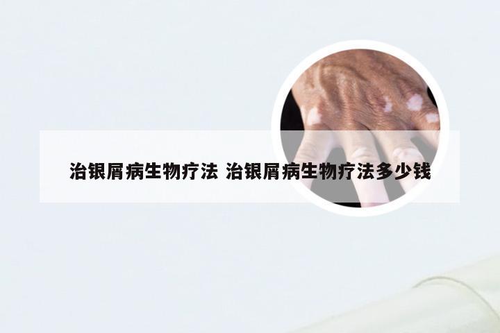 治银屑病生物疗法 治银屑病生物疗法多少钱
