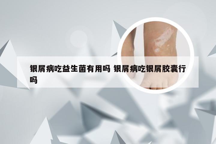 银屑病吃益生菌有用吗 银屑病吃银屑胶囊行吗