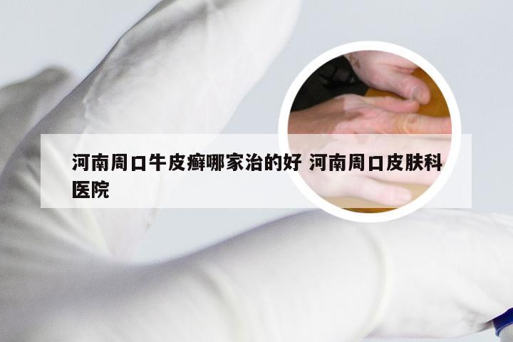 河南周口牛皮癣哪家治的好 河南周口皮肤科医院
