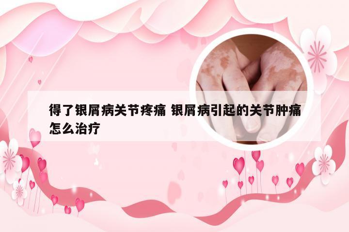 得了银屑病关节疼痛 银屑病引起的关节肿痛怎么治疗