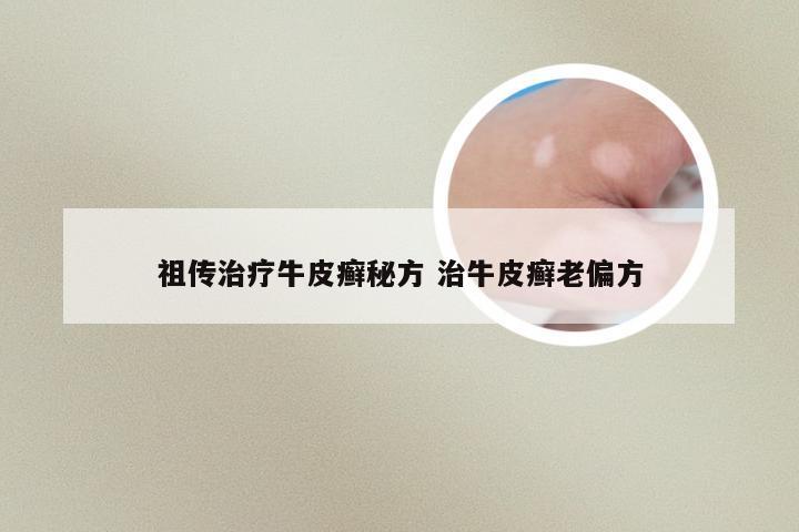 祖传治疗牛皮癣秘方 治牛皮癣老偏方