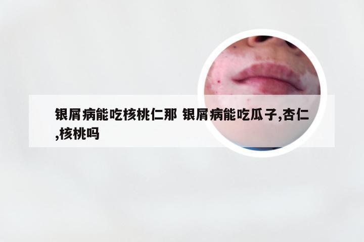 银屑病能吃核桃仁那 银屑病能吃瓜子,杏仁,核桃吗
