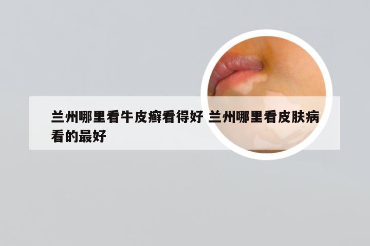 兰州哪里看牛皮癣看得好 兰州哪里看皮肤病看的最好