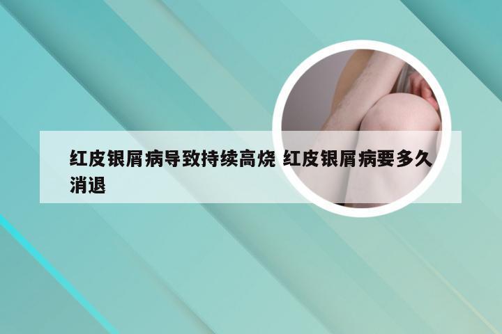 红皮银屑病导致持续高烧 红皮银屑病要多久消退