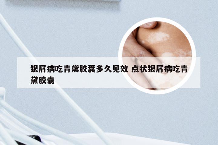 银屑病吃青黛胶囊多久见效 点状银屑病吃青黛胶囊
