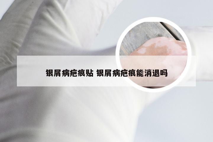 银屑病疤痕贴 银屑病疤痕能消退吗