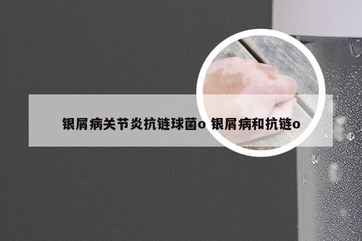 银屑病关节炎抗链球菌o 银屑病和抗链o