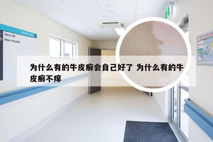 为什么有的牛皮癣会自己好了 为什么有的牛皮癣不痒