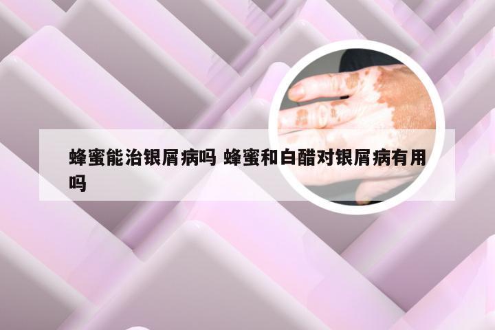 蜂蜜能治银屑病吗 蜂蜜和白醋对银屑病有用吗