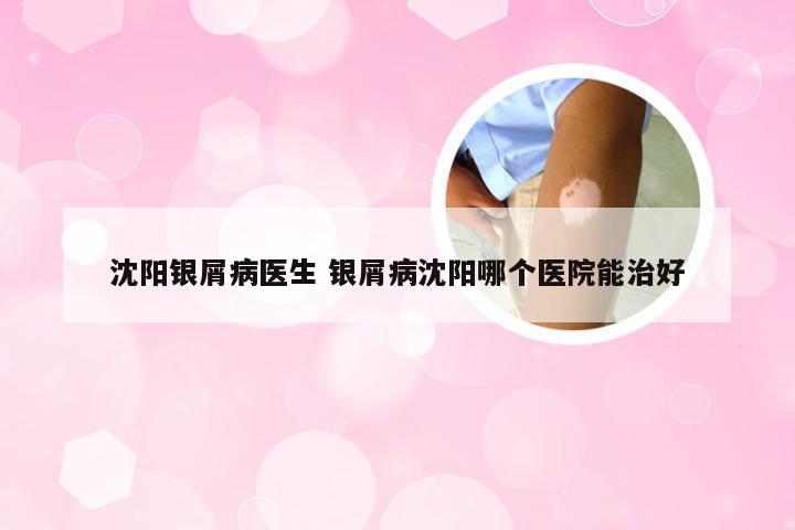 沈阳银屑病医生 银屑病沈阳哪个医院能治好