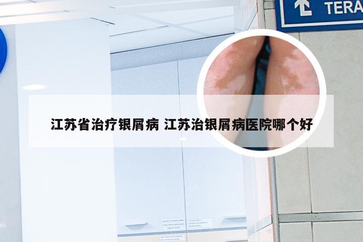 江苏省治疗银屑病 江苏治银屑病医院哪个好
