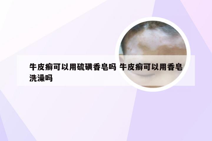牛皮癣可以用硫磺香皂吗 牛皮癣可以用香皂洗澡吗
