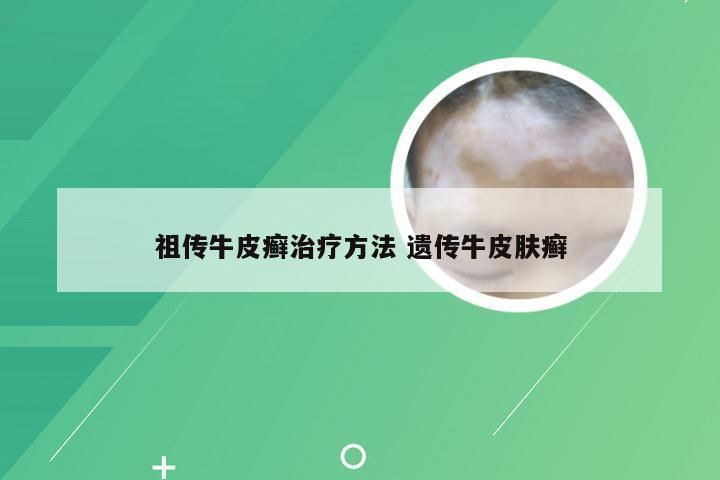 祖传牛皮癣治疗方法 遗传牛皮肤癣